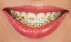gold braces